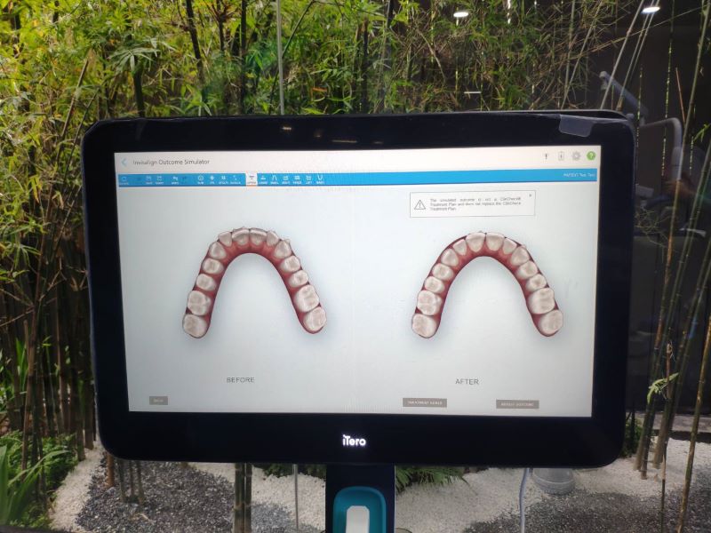 présentation d'invisalign