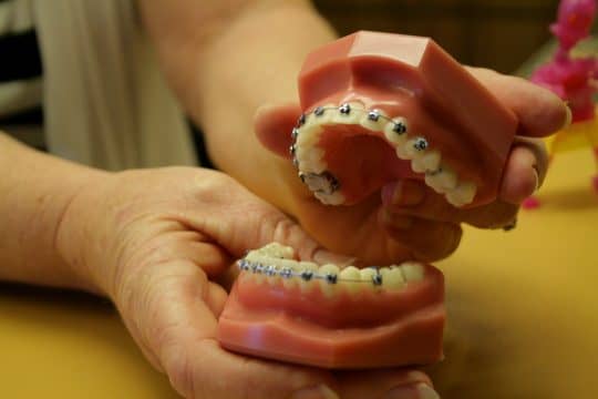 braces mold